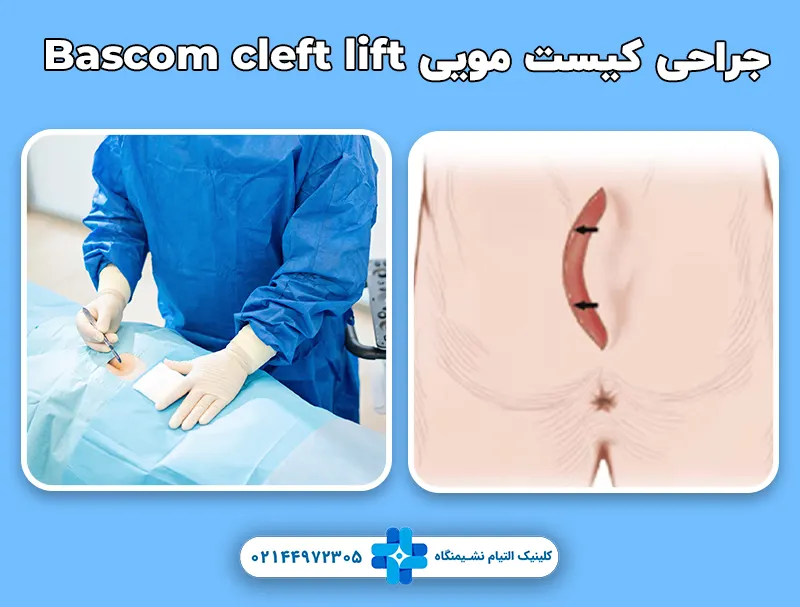 جراحی کیست مویی به روش Bascom cleft lift