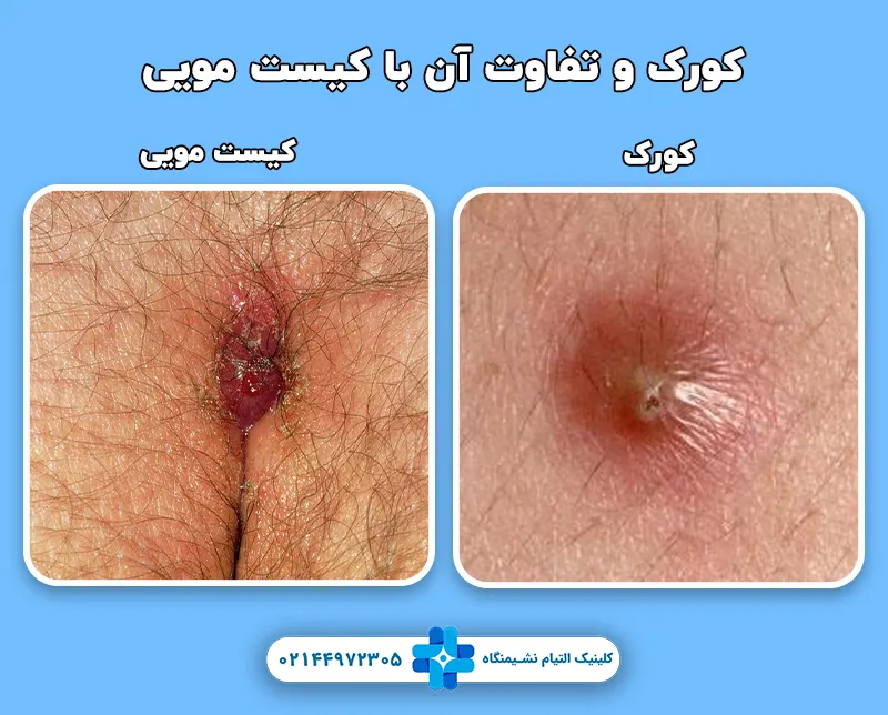 کورک و تفاوت آن با کیست مویی