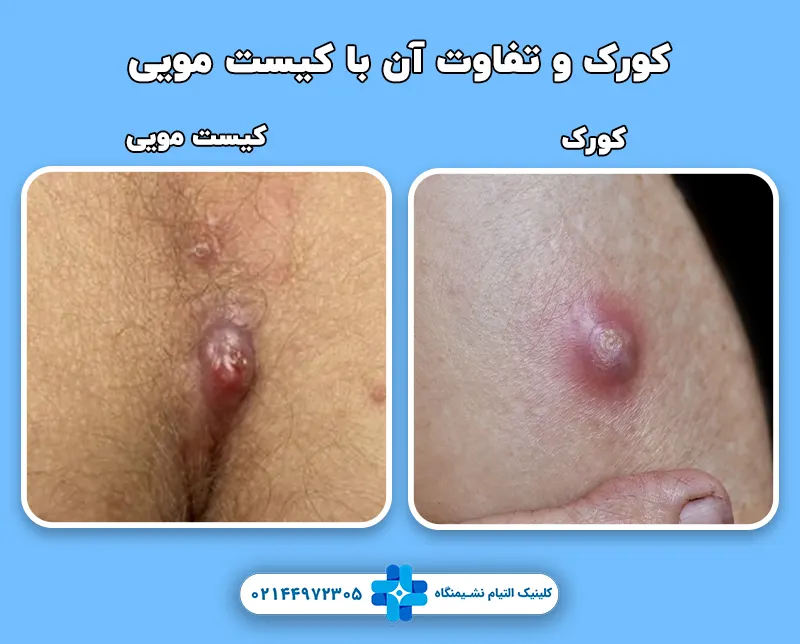 کورک و تفاوت آن با کیست مویی