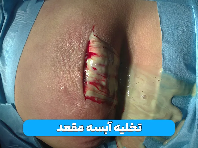 تخلیه آبسه مقعد