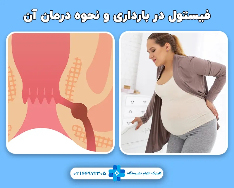 فیستول در بارداری