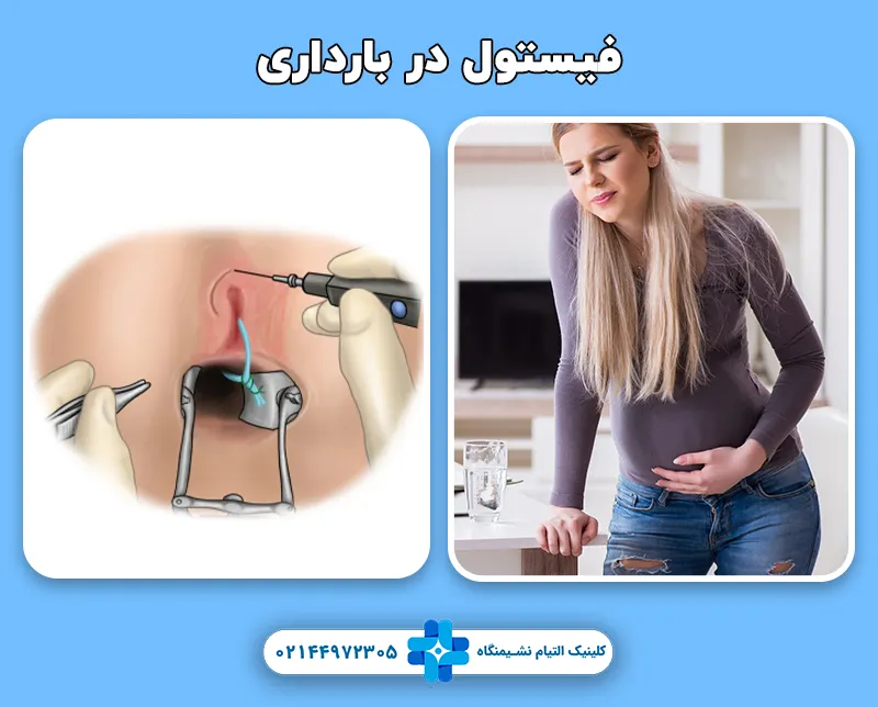 فیستول در بارداری