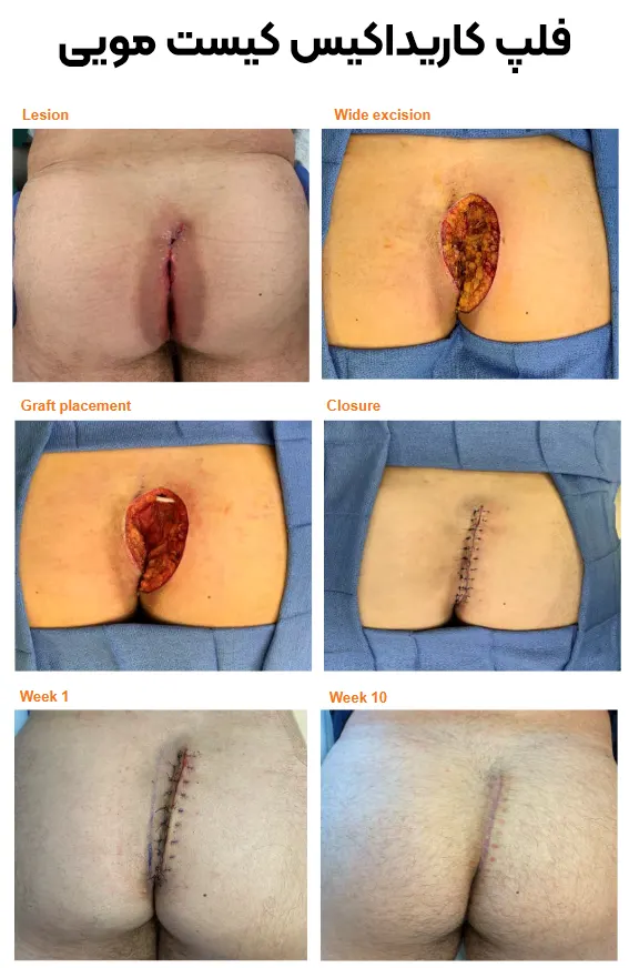 جراحی فلپ کاریداکیس