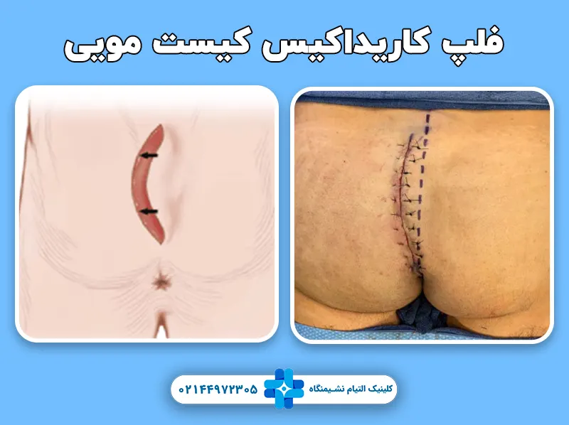 فلپ کاریداکیس کیست مویی