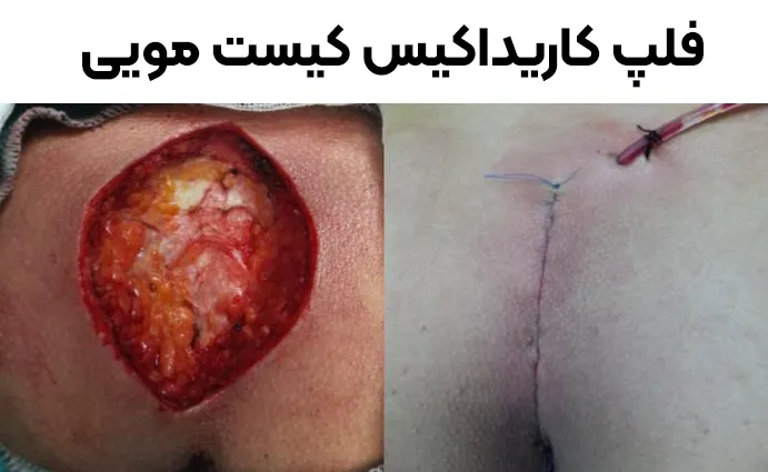 جراحی فلپ کاریداکیس