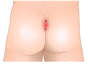 جراحی فلپ کاریداکیس