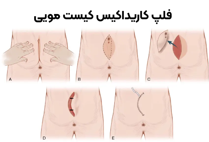 جراحی فلپ کاریداکیس