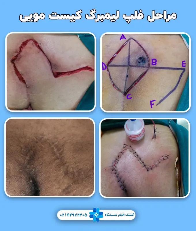 مراحل جراحی فلپ لیمبرگ کیست مویی