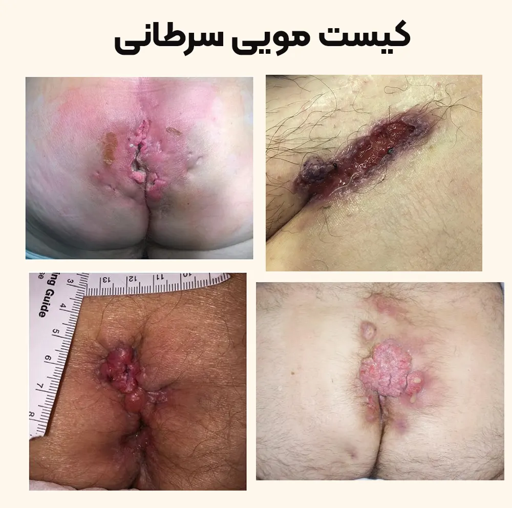 سرطان کیست مویی