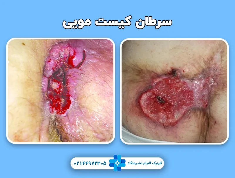 سرطان کیست مویی