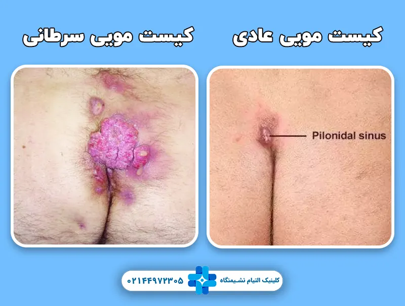 تفاوت بین کیست مویی بدخیم و عادی