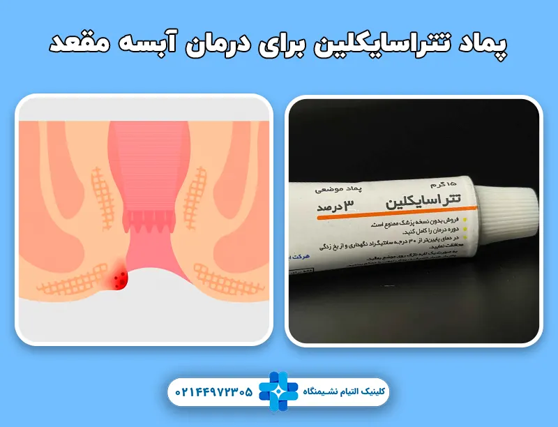 بهترین پماد برای جوش مقعدی