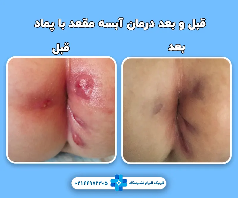 بهترین پماد برای جوش مقعدی