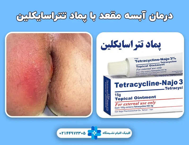 بهترین پماد برای جوش مقعدی
