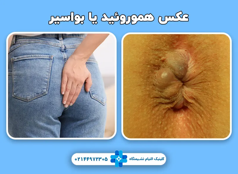 بواسیر یا هموروئید