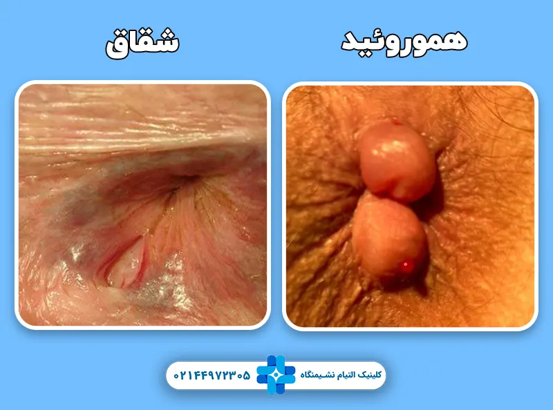 شقاق و هموروئید
