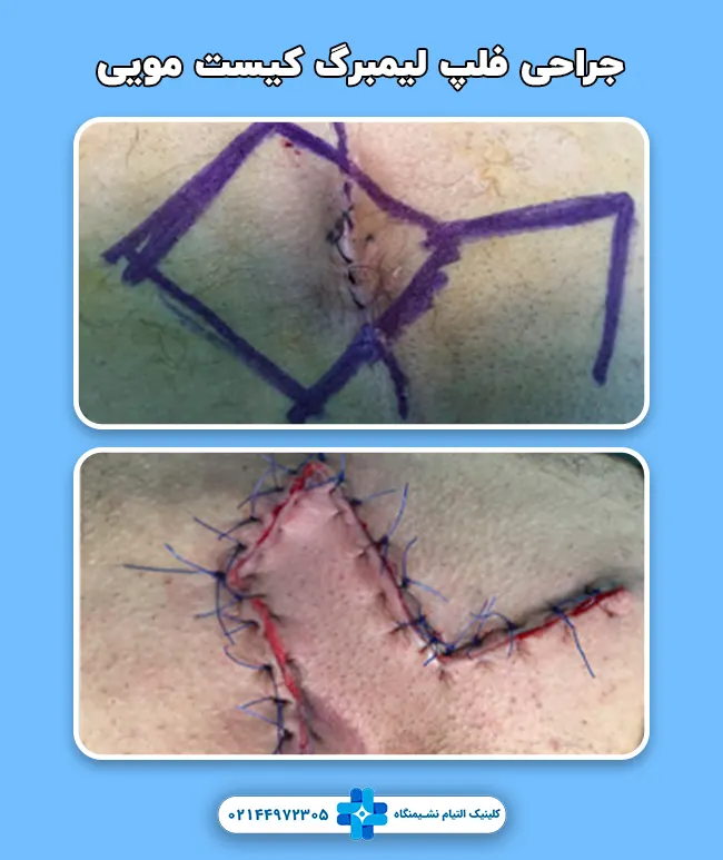 فلپ لیمبرگ کیست مویی