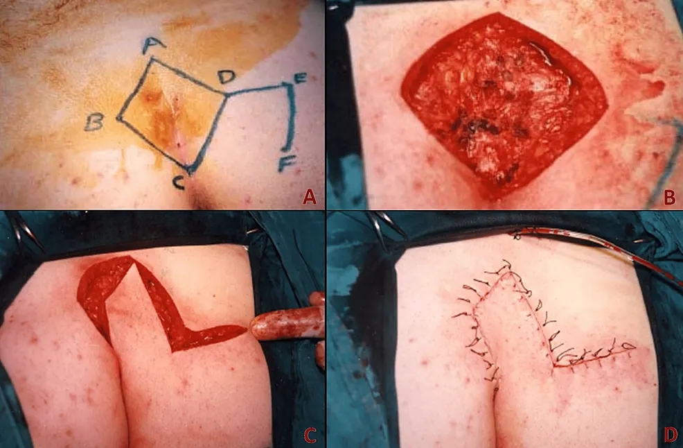 جراحی فلپ لیمبرگ کیست مویی