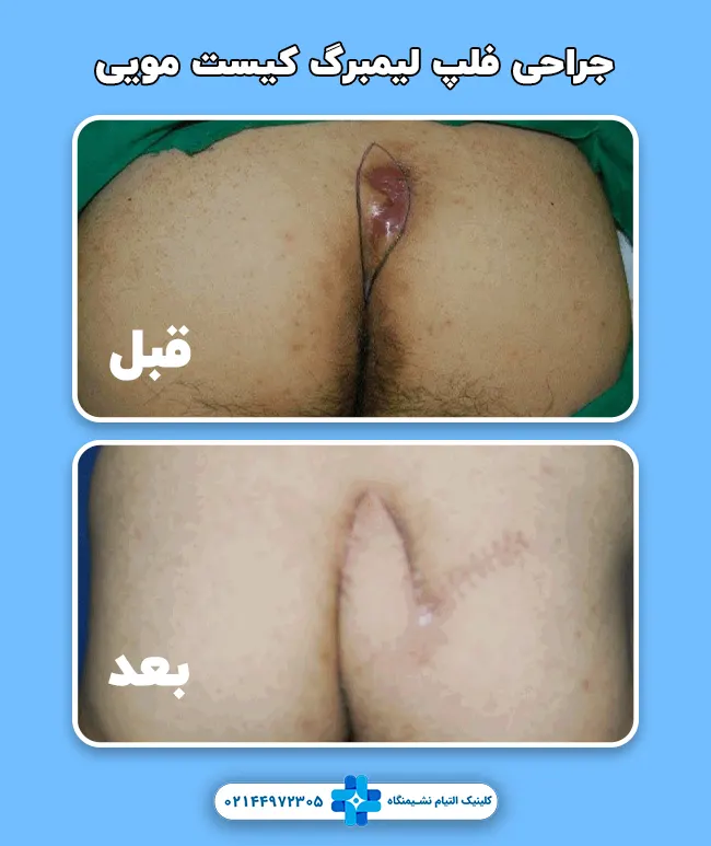 فلپ لیمبرگ کیست مویی