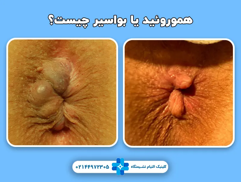 عکس ههموروئید