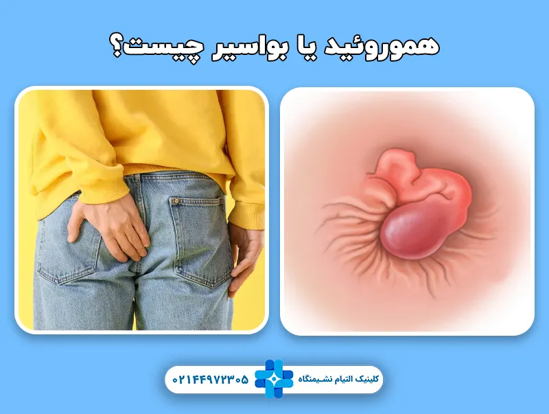 هموروئید یا بواسیر چیست؟