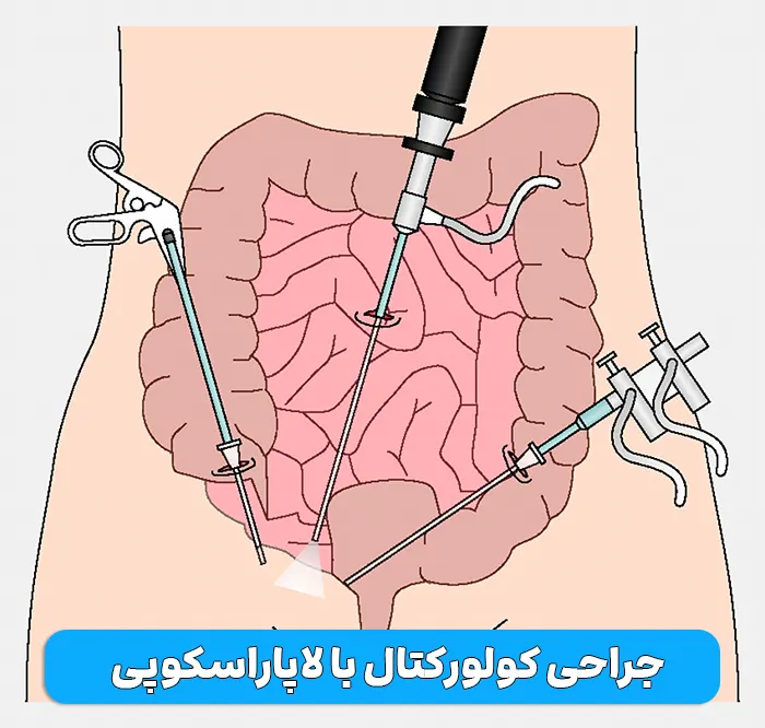 جراحی کولورکتال با لاپاراسکوپی