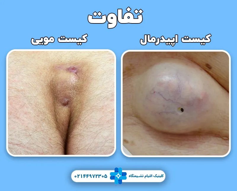 تفاوت کیست مویی با کیست اپیدرمال