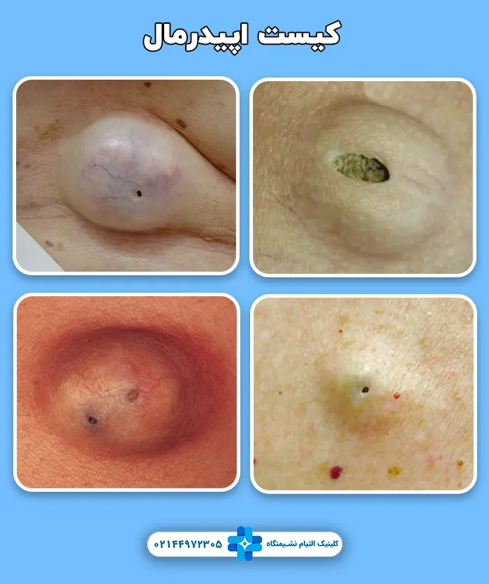 کیست اپیدرمال