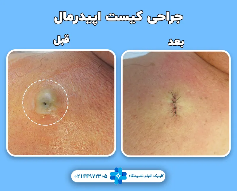 جراحی کیست اپیدرمال