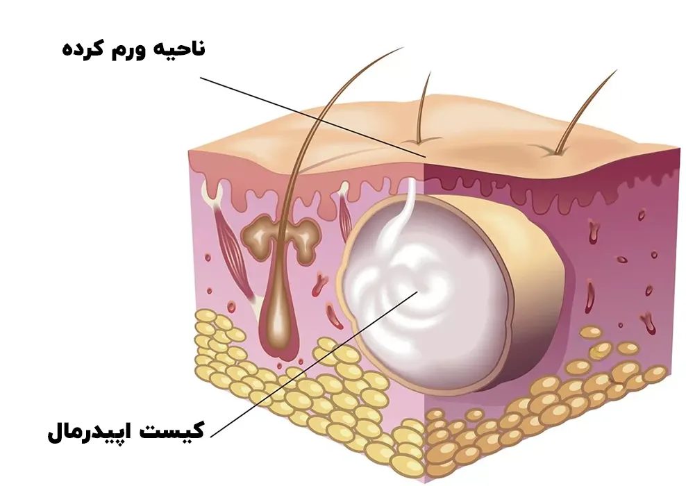 کیست اپیدرمال چیست