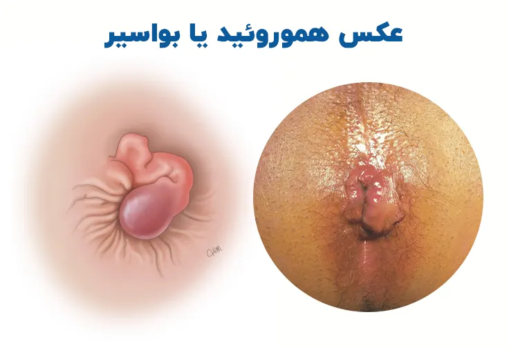 عکس هموروئید خارجی