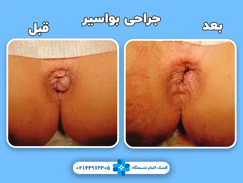 جراحی بواسیر