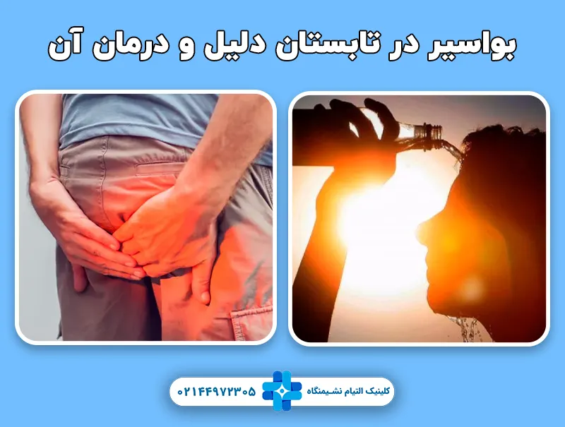 بواسیر در تابستان دلیل و درمان آن