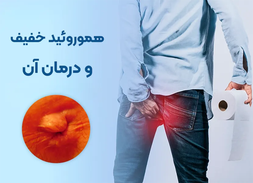 هموروئید خفیف و درمان آن
