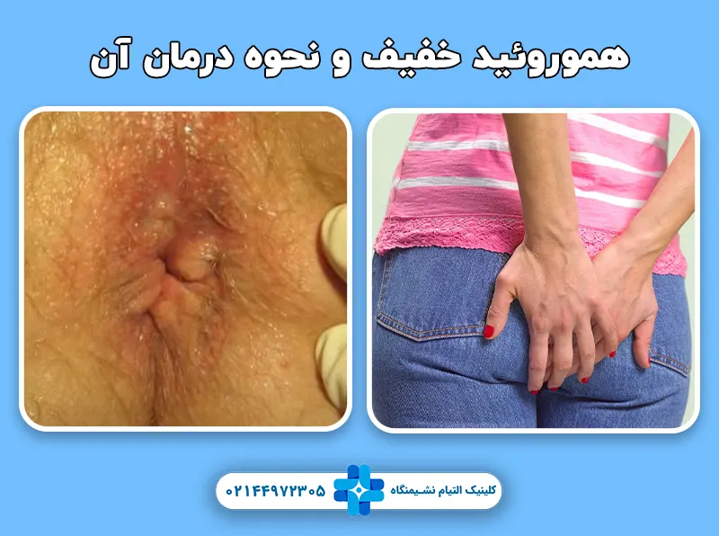 هموروئید خفیف و درمان آن