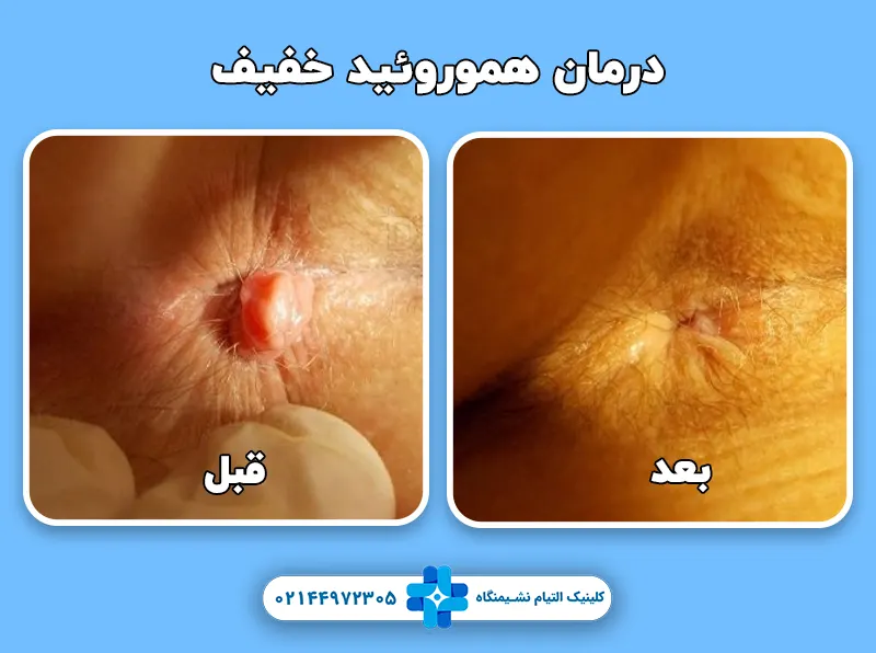 درمان هموروئید خفیف