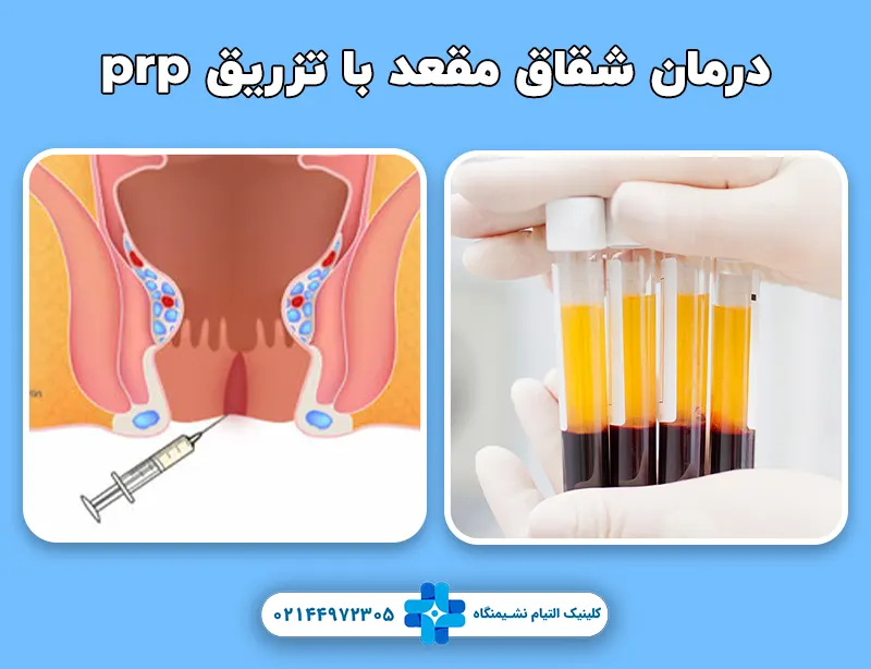 درمان شقاق مقعد با تزریق prp