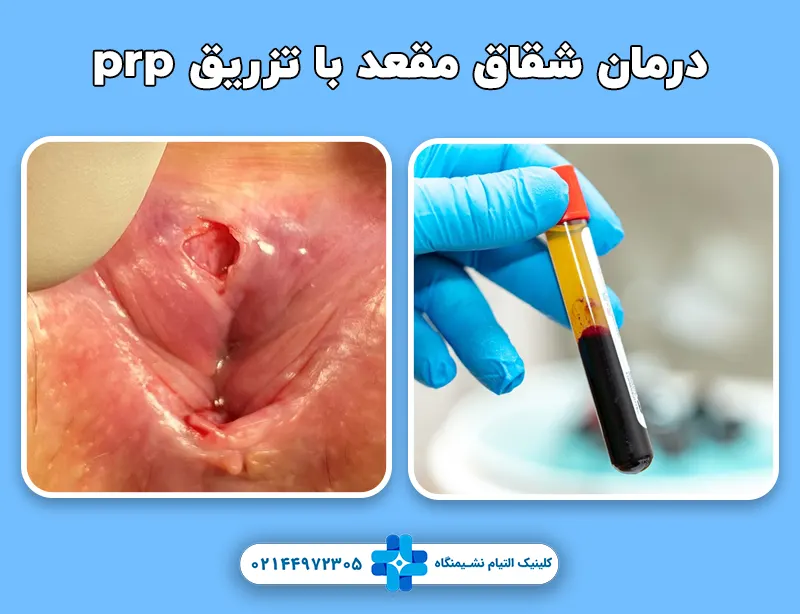 درمان شقاق مقعد با تزریق prp
