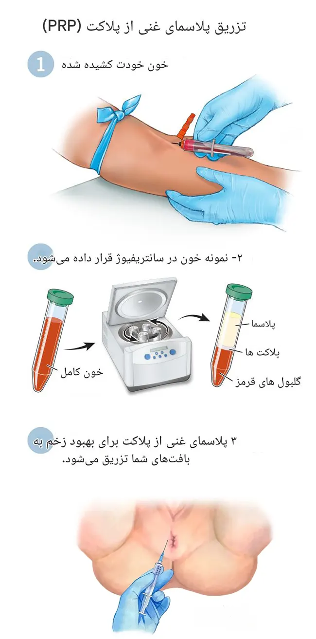 درمان شقاق مقعد با تزریق prp