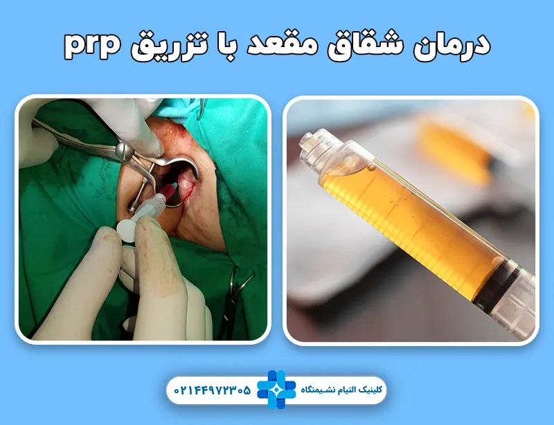درمان شقاق مقعد با تزریق prp