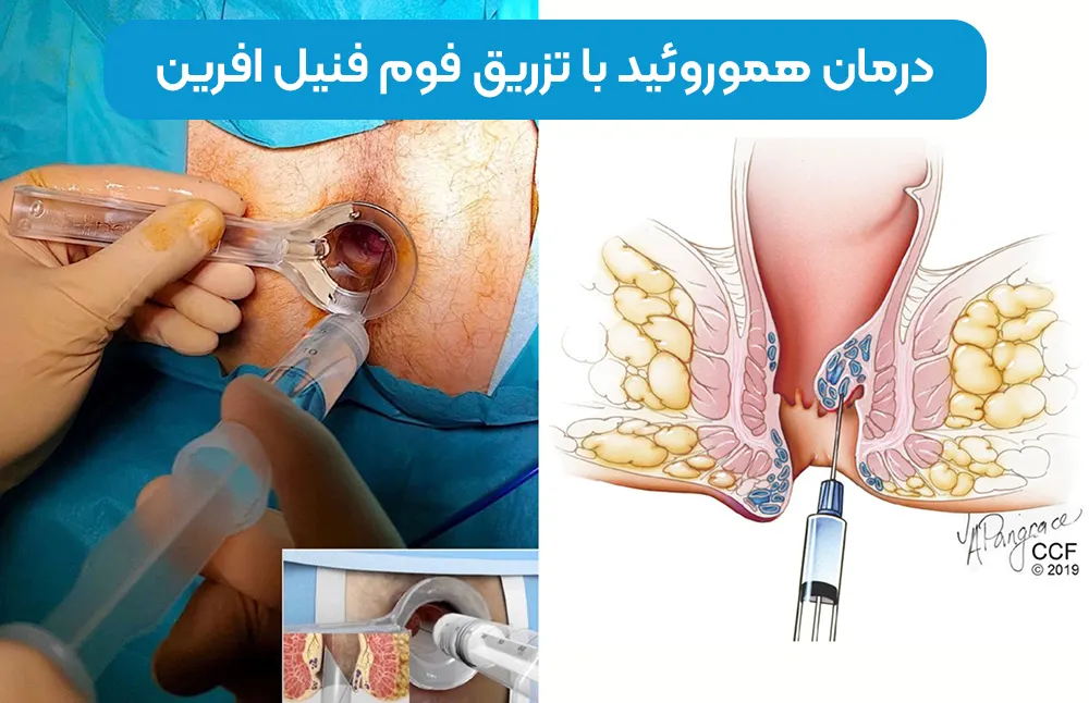 درمان هموروئید با تزریق فوم فنیل افرین
