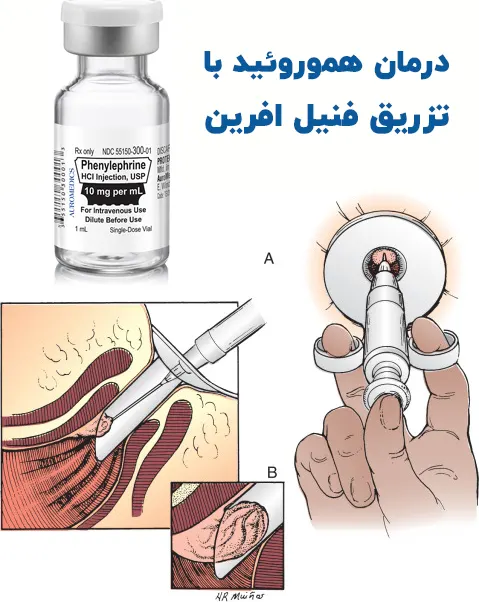 درمان هموروئید با تزریق فنیل افرین