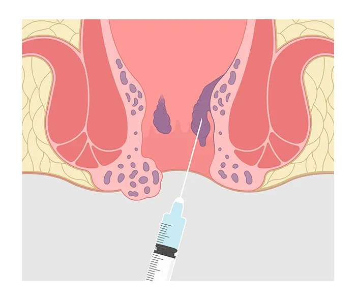 درمان هموروئید با تزریق فنیل افرین