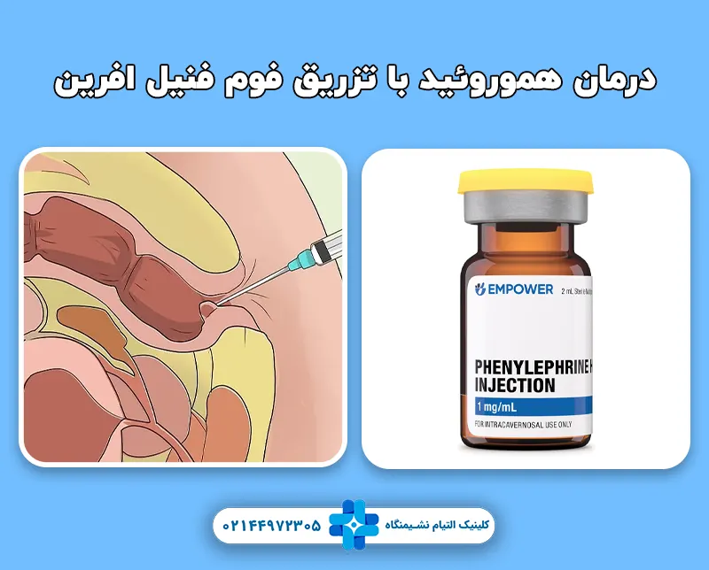 درمان هموروئید با تزریق فوم فنیل افرین