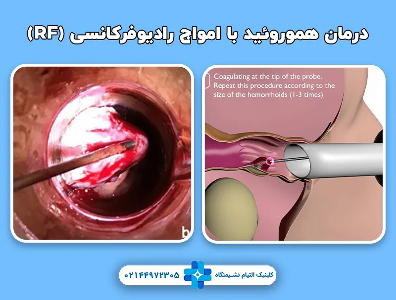 درمان هموروئید با امواج رادیوفرکانسی (RF)