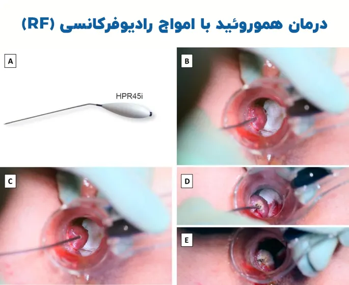 درمان هموروئید با امواج رادیوفرکانسی