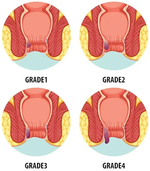 گرید بواسیر