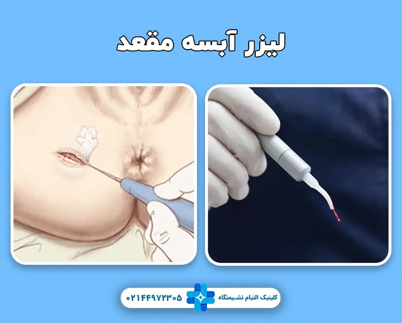 لیزر آبسه مقعد