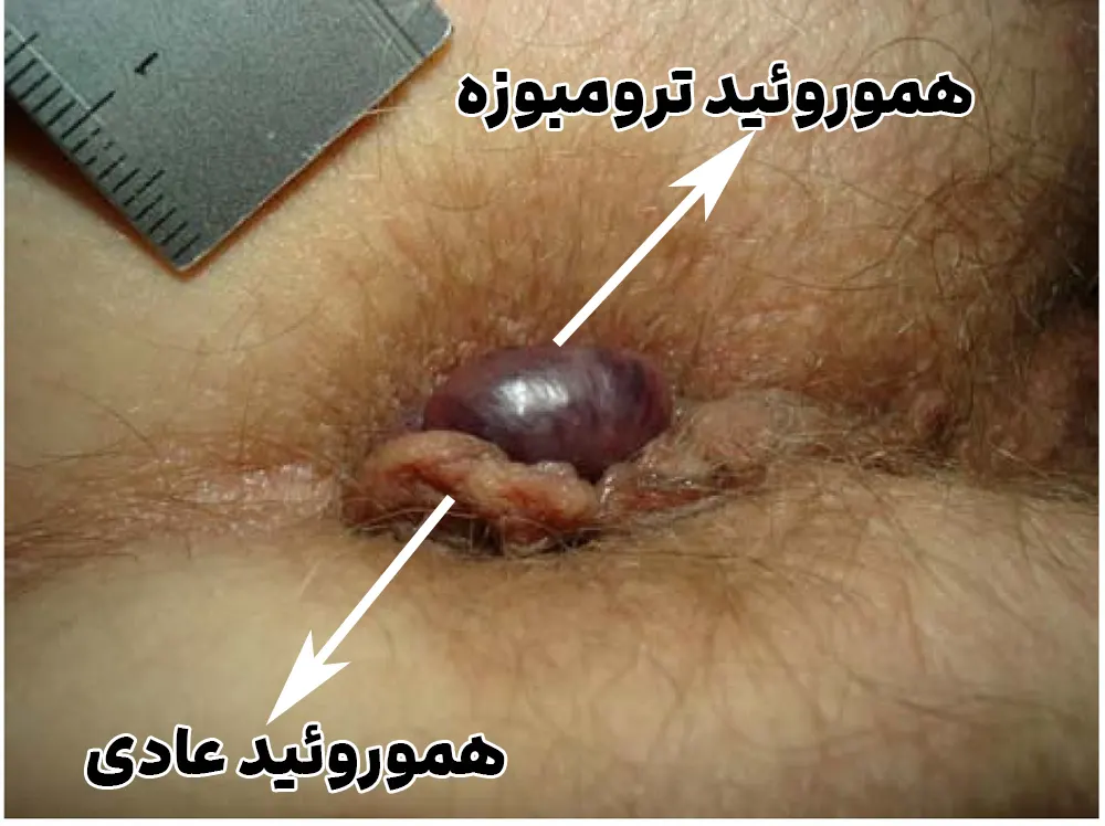 تفاوت هموروئید ترومبوزه با عادی
