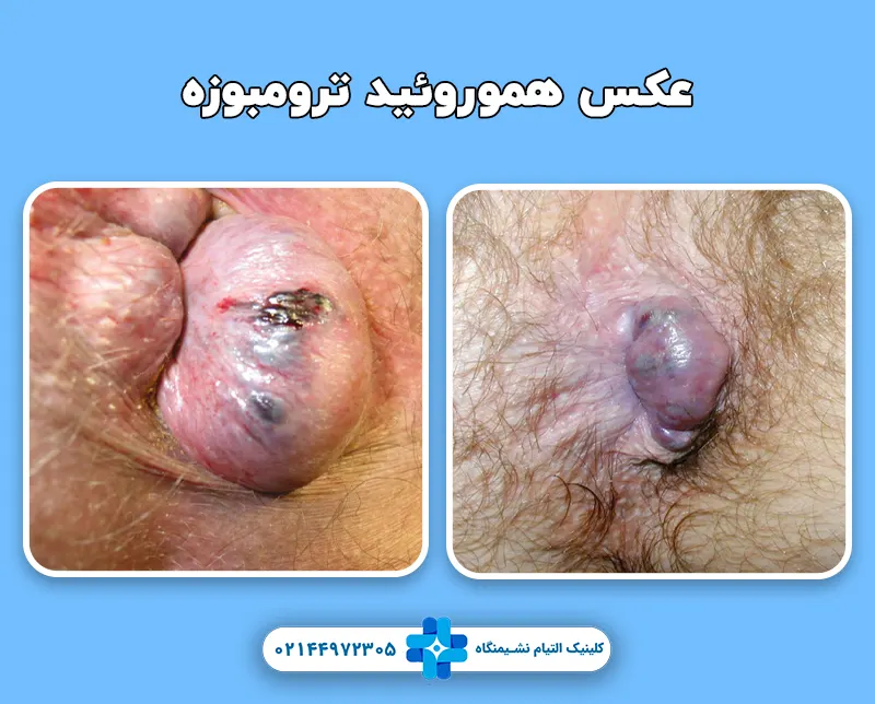 هموروئید ترومبوزه